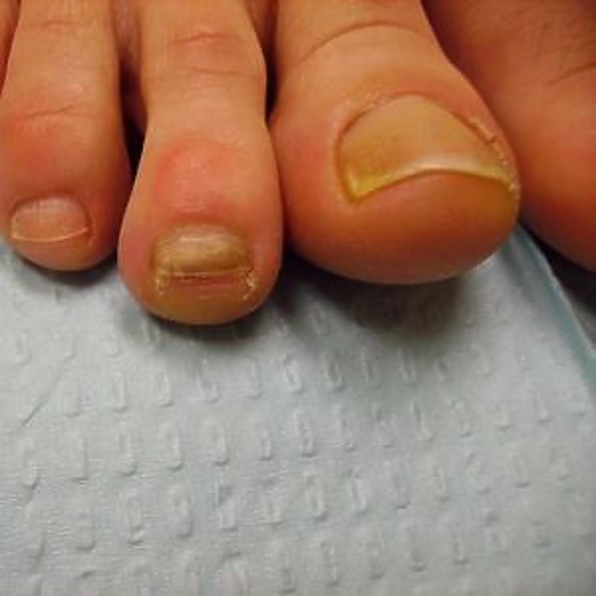 pozolke paznokcie u stop powstrzymuja cie przed noszeniem sandalkow znamy domowy patent na ten problem christmas nails pink nail art new design