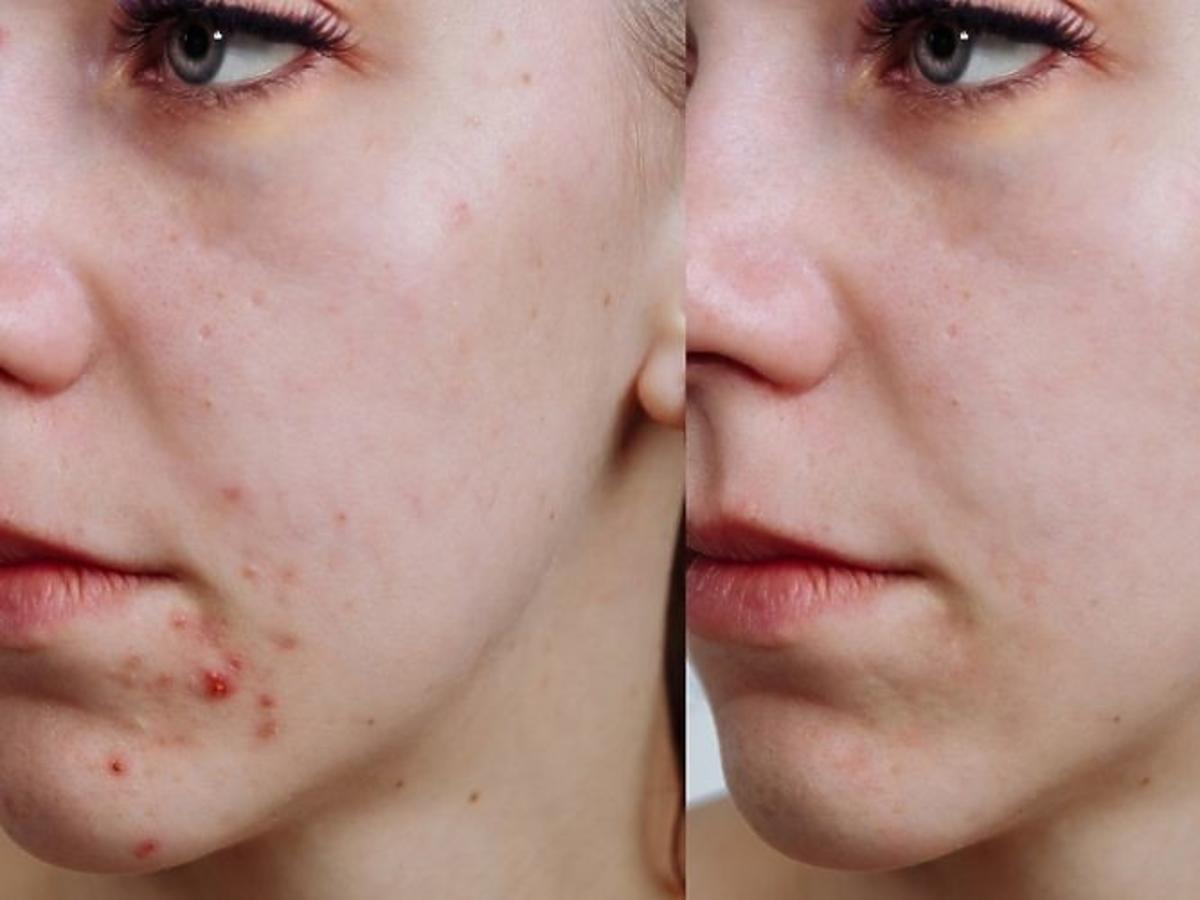 acne derm efekty 