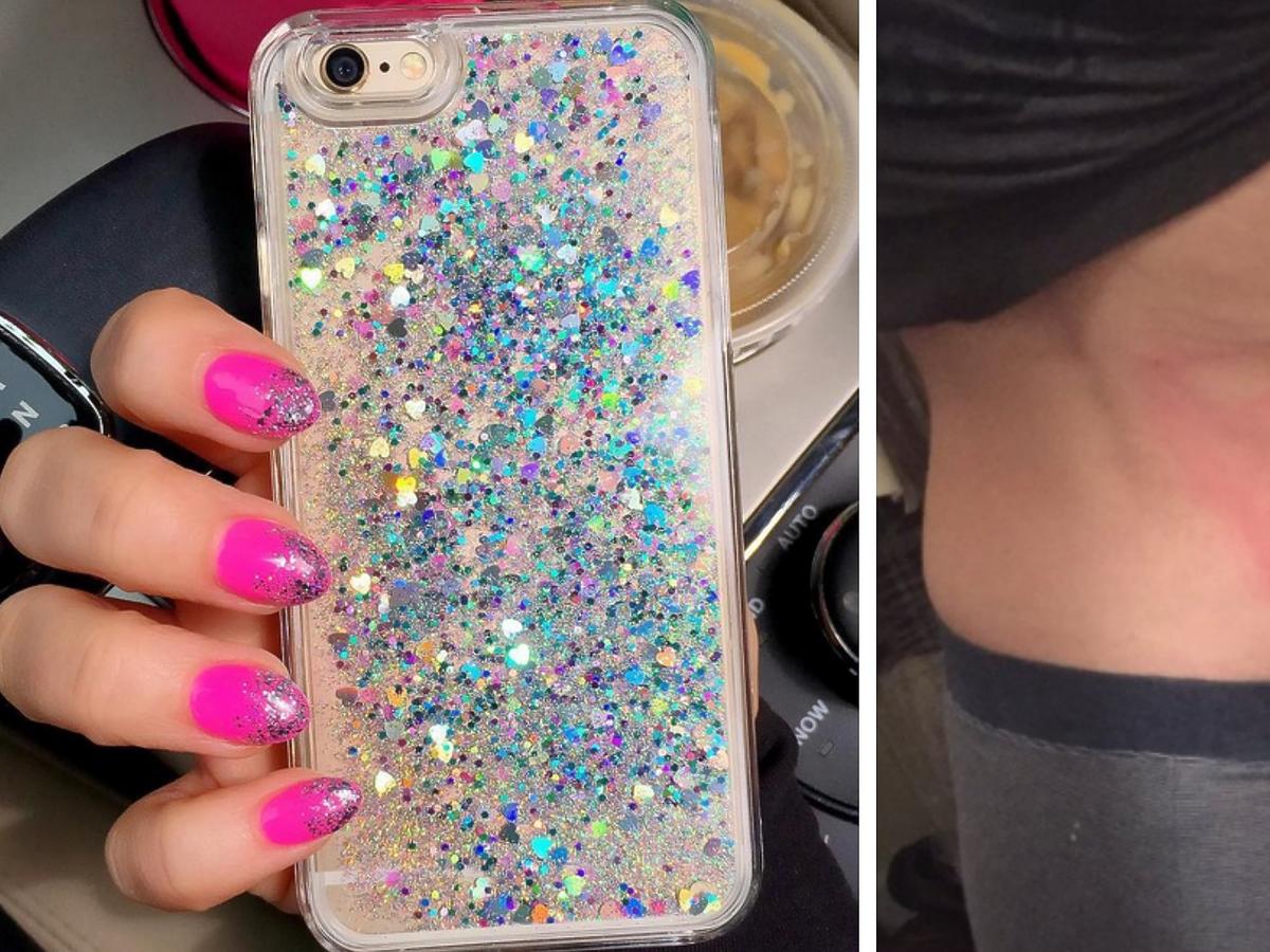 brokatowy case na iPhonea oparzenia skóry