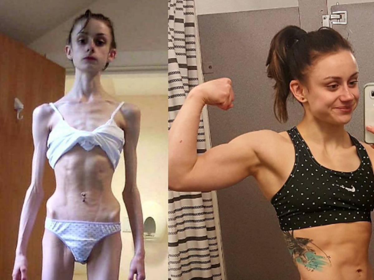 Dziewczyna pokazuje, jak wyglądała cierpiąc na anoreksję i po tym, jak przytyła