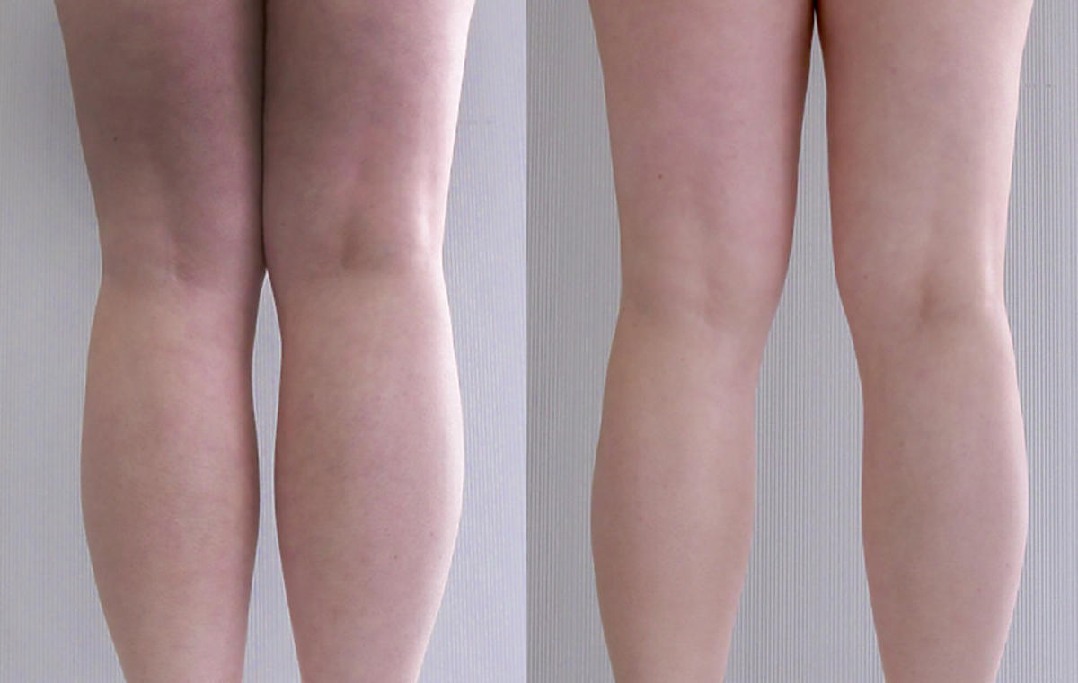 efekty zabiegu Onda w SkinClinic