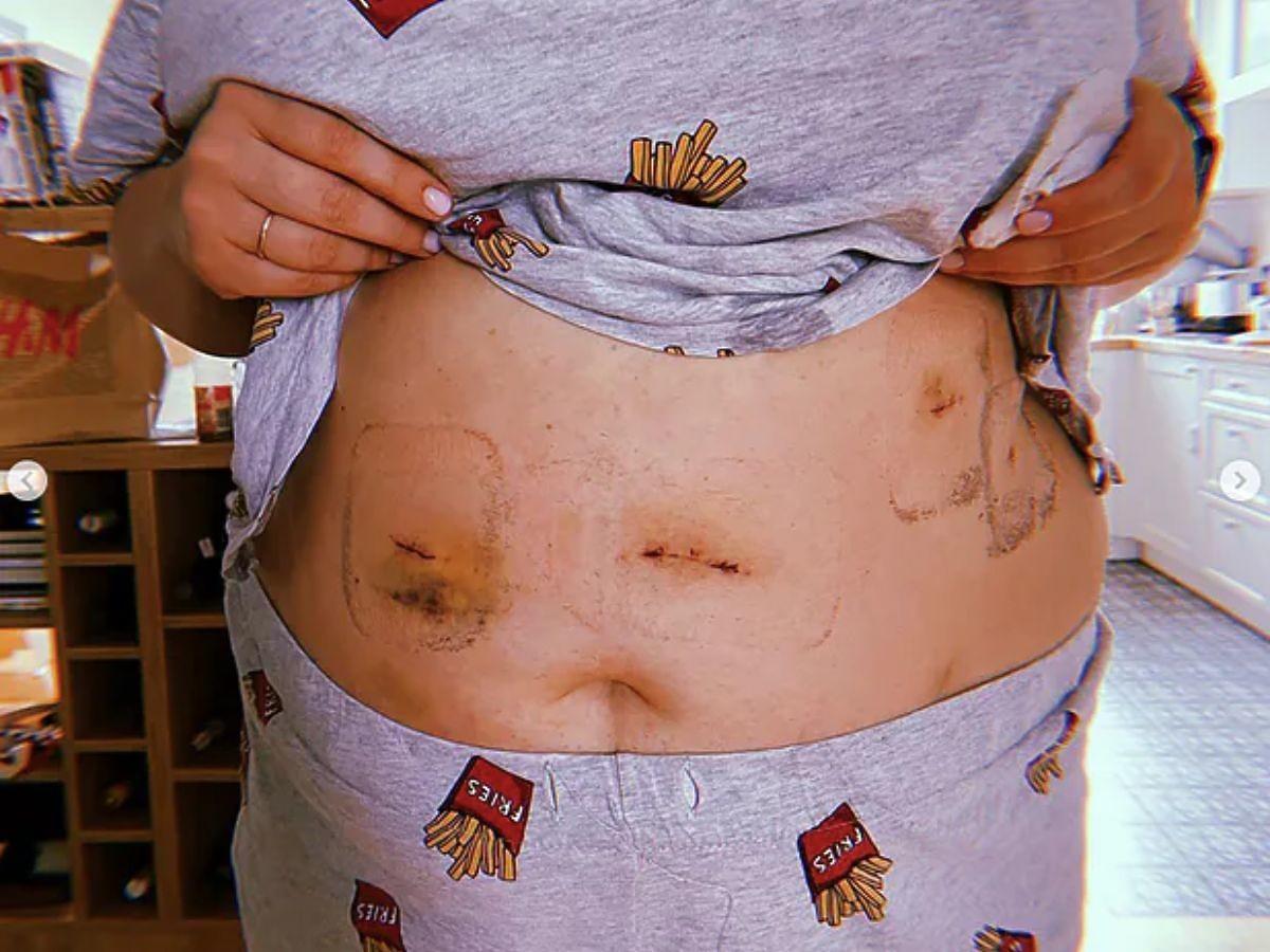 Justyna Mazur pokazuje brzuch i blizny po operacji zmniejszenia żołądka