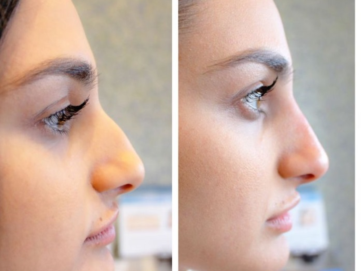 korekta nosa wypełniaczem zdjęcia przed i po