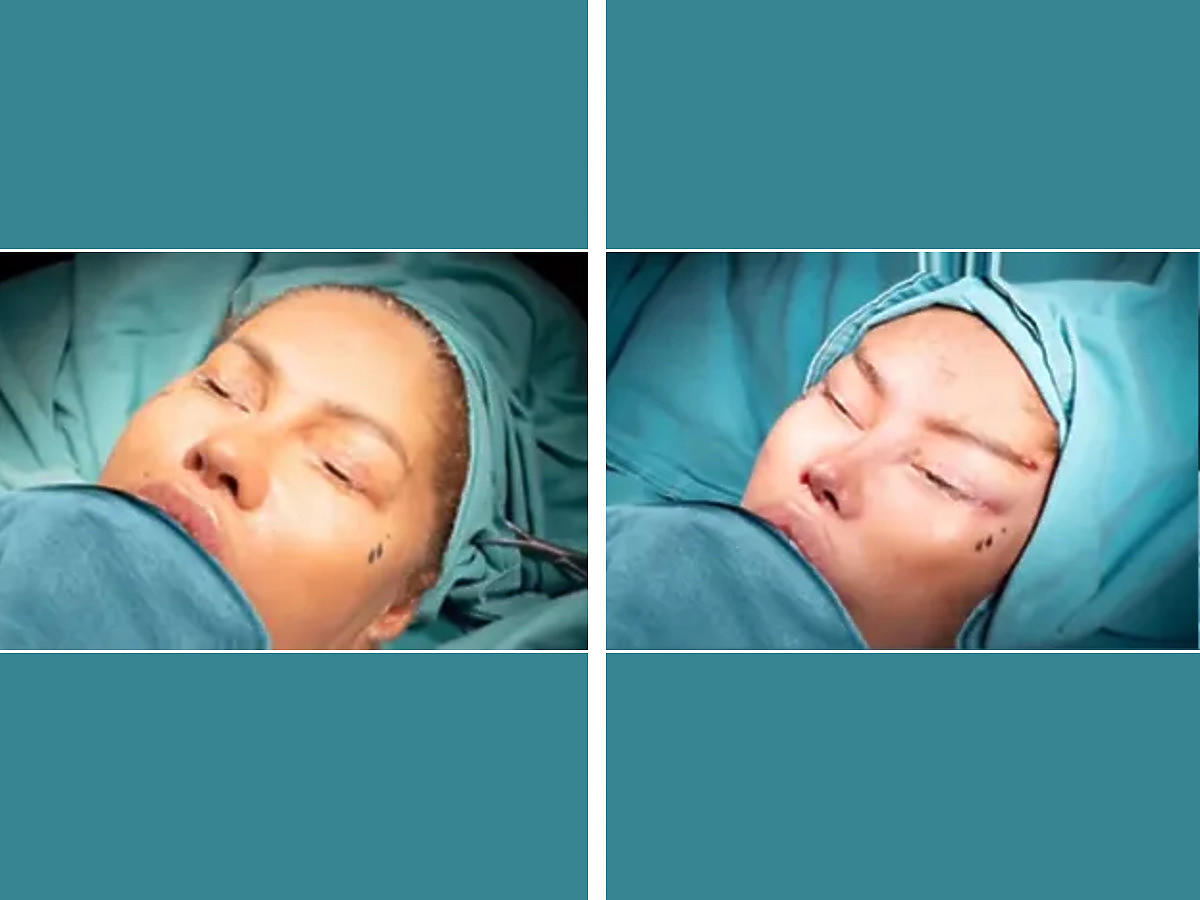 Królowe życia - Laluna przed i po operacji plastycznej całej twarzy (1)