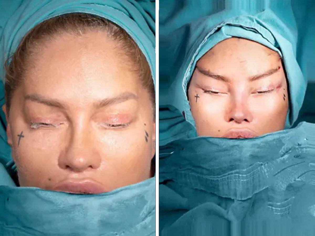 Królowe życia - Laluna przed i po operacji plastycznej całej twarzy