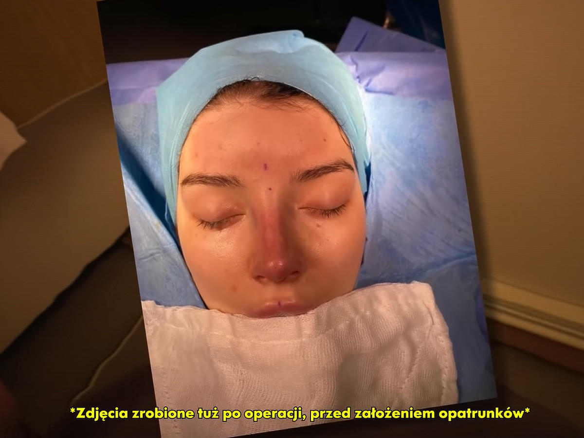 Marcysia z Ekipy jest po operacji nosa