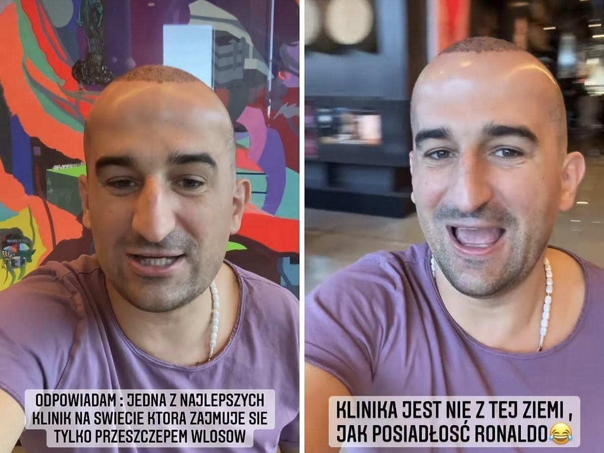 Misiek Koterski po przeszczepie włosów w Turcji