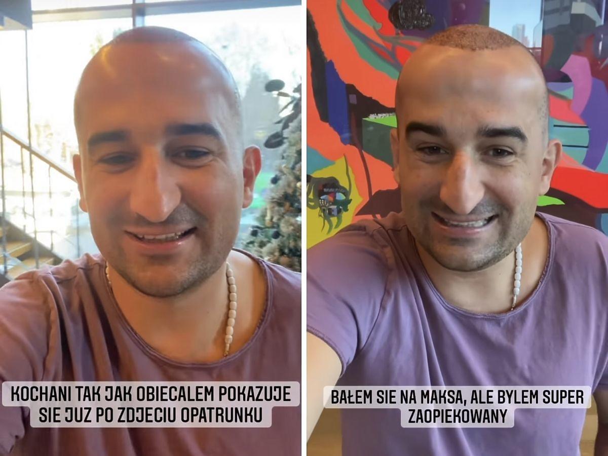 Misiek Koterski pokazuje efekt przeszczepu włosów w Turcji