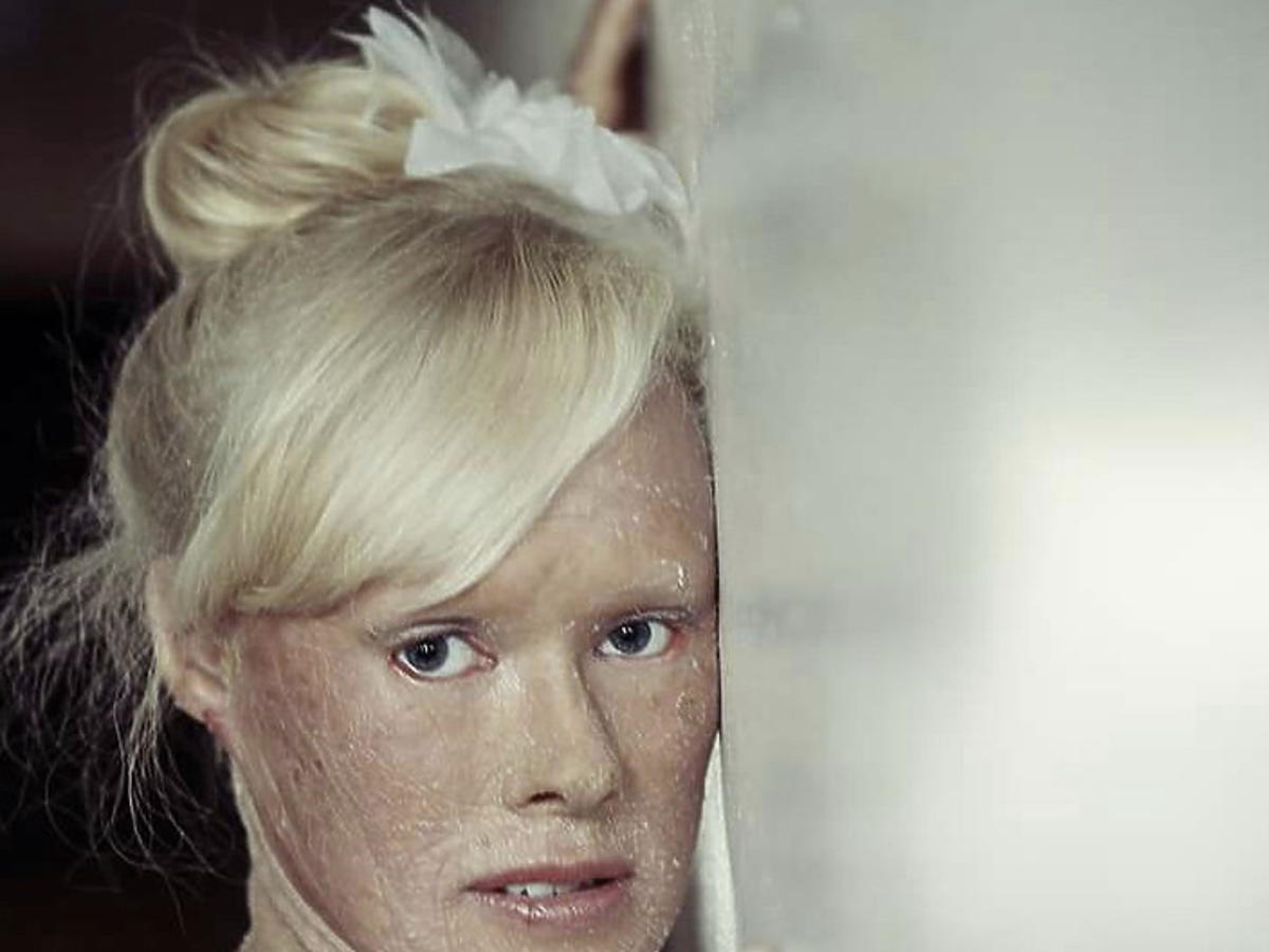 miss z choroba skóry