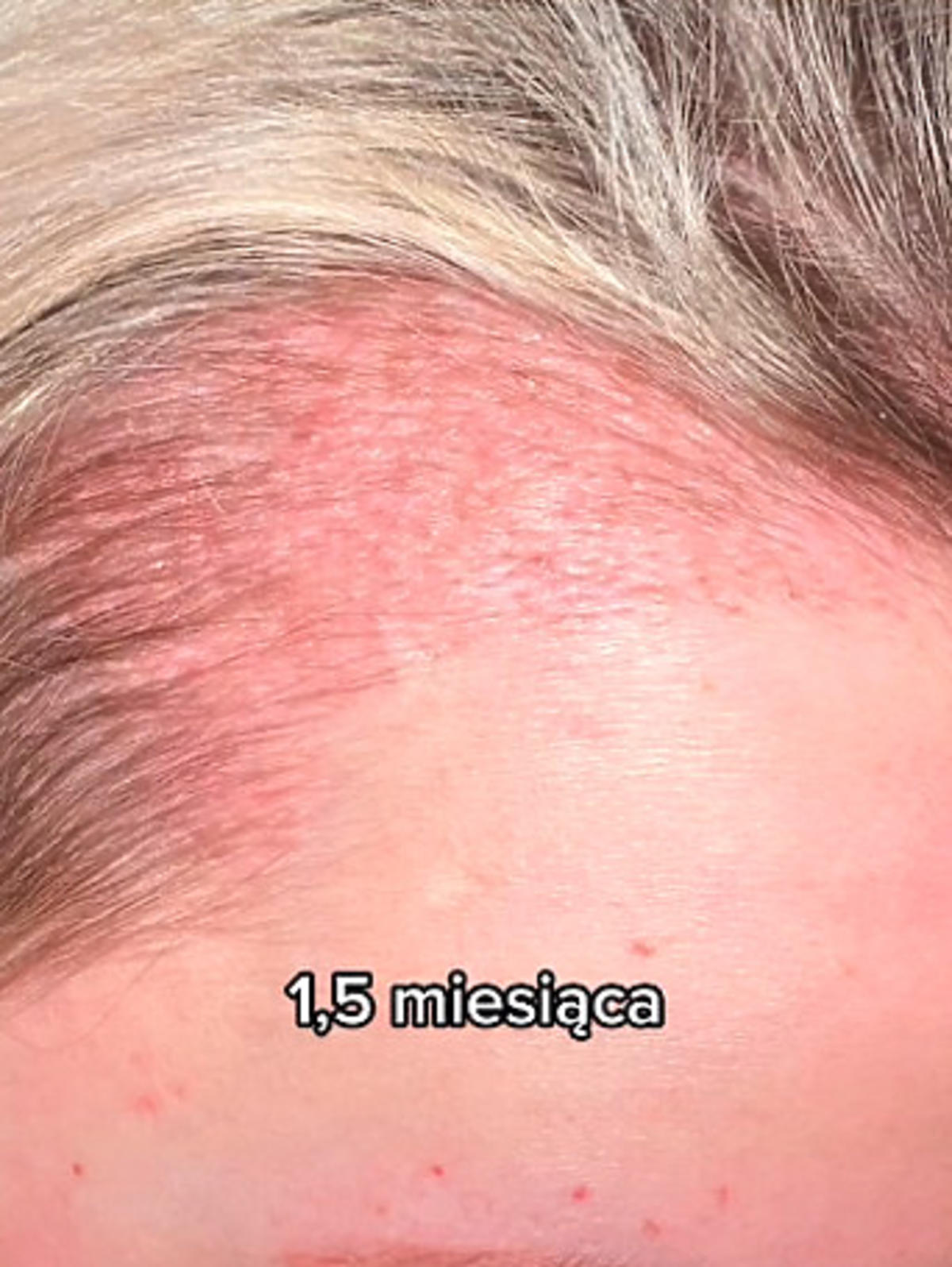 Monika Miller pokazała efekty przeszczepu włosów