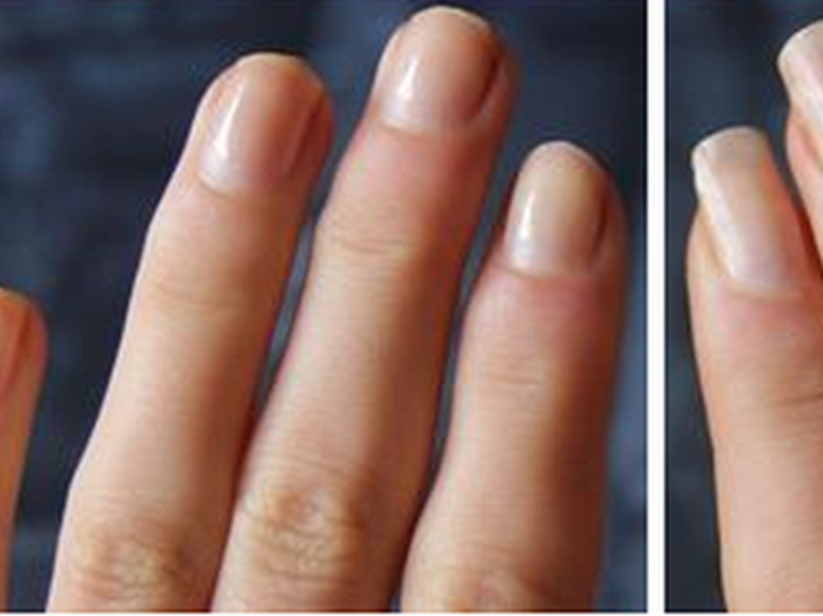 paznokcie przed i po przyspieszony porost dzięki odżywcze