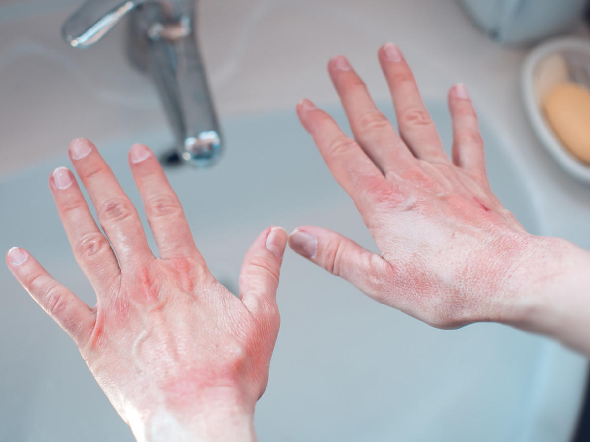 pękająca skóra na dłoniach