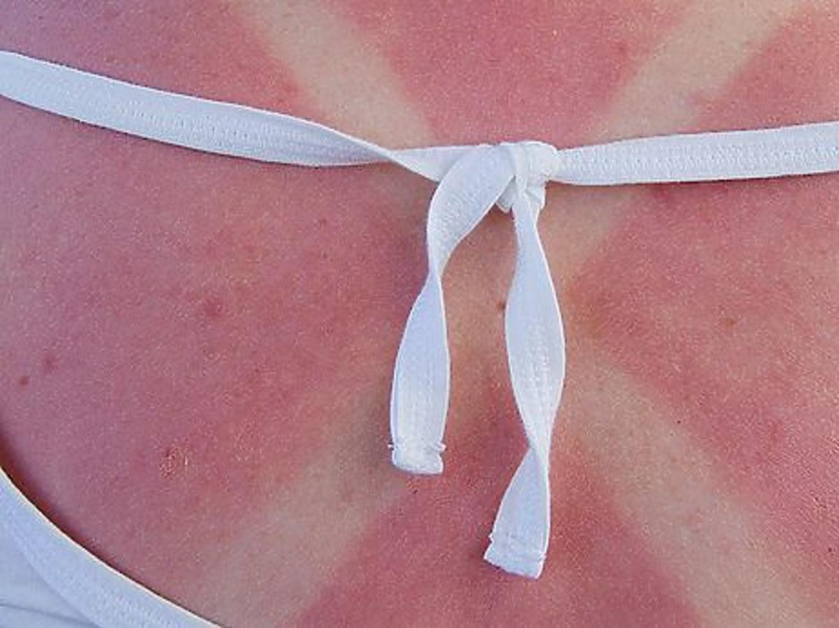 poparzenia słoneczne na plecach czerwona skóra po opalaniu