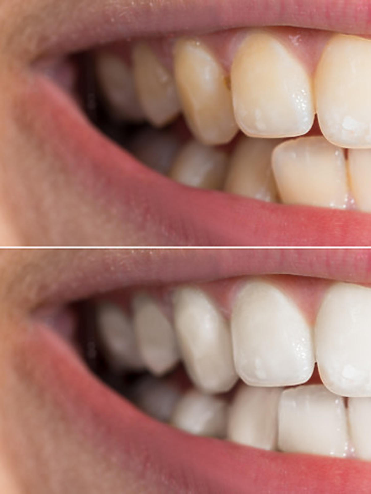 proszek wybielający zęby - efekt