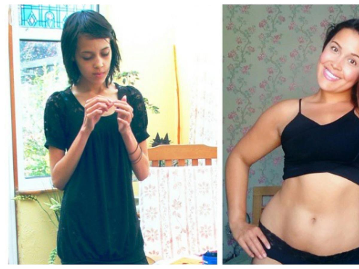 przed i po anoreksja 