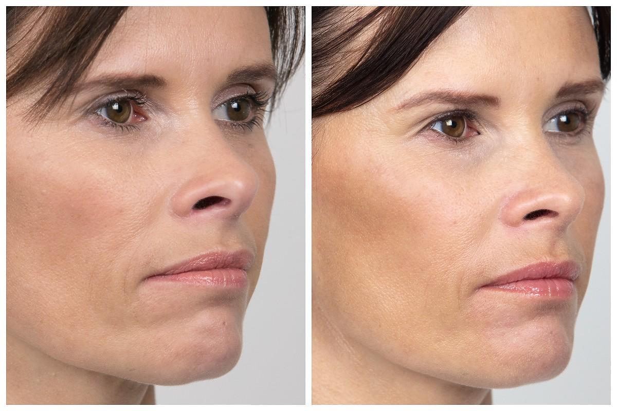 sculptra efekty