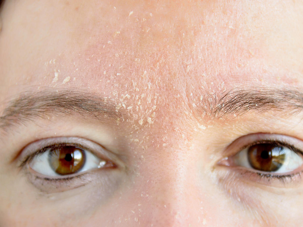 sucha skóra twarzy przed zastosowaniem kremu z cholesterolem