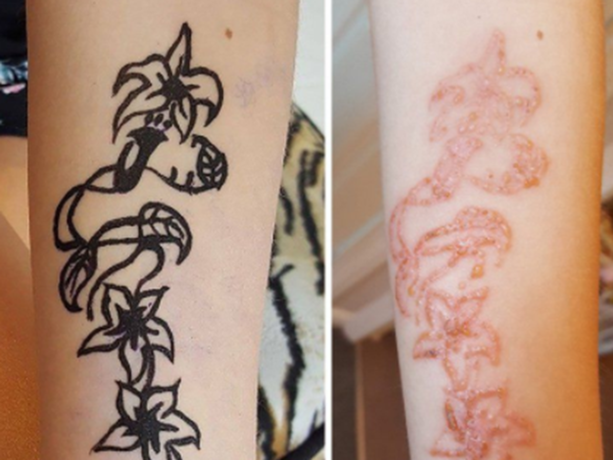 tatuaż z czarnej henny reakcja alergiczna