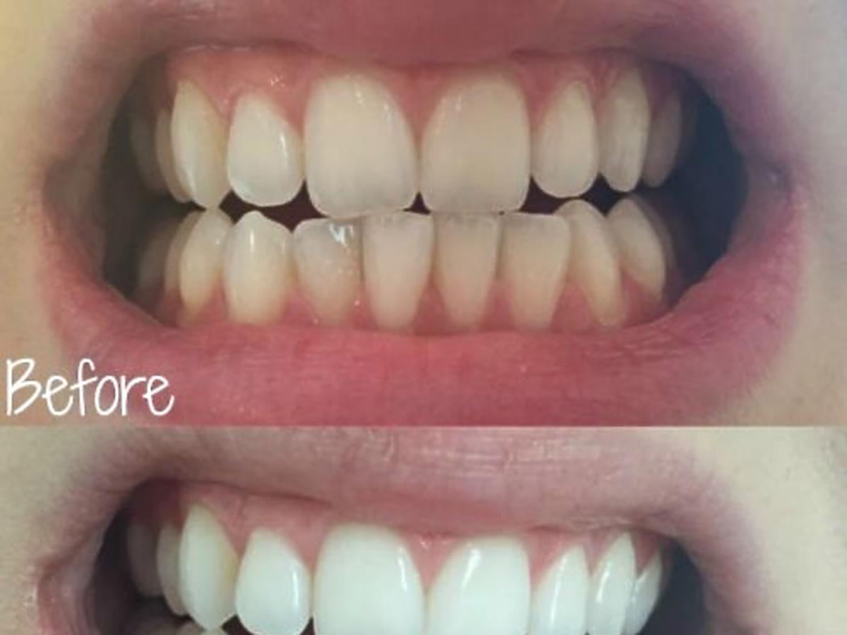 wybielone zęby zdjęcie przed i po