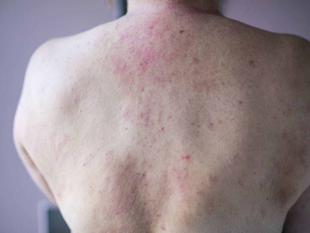 Wysypka alergiczna na plecach