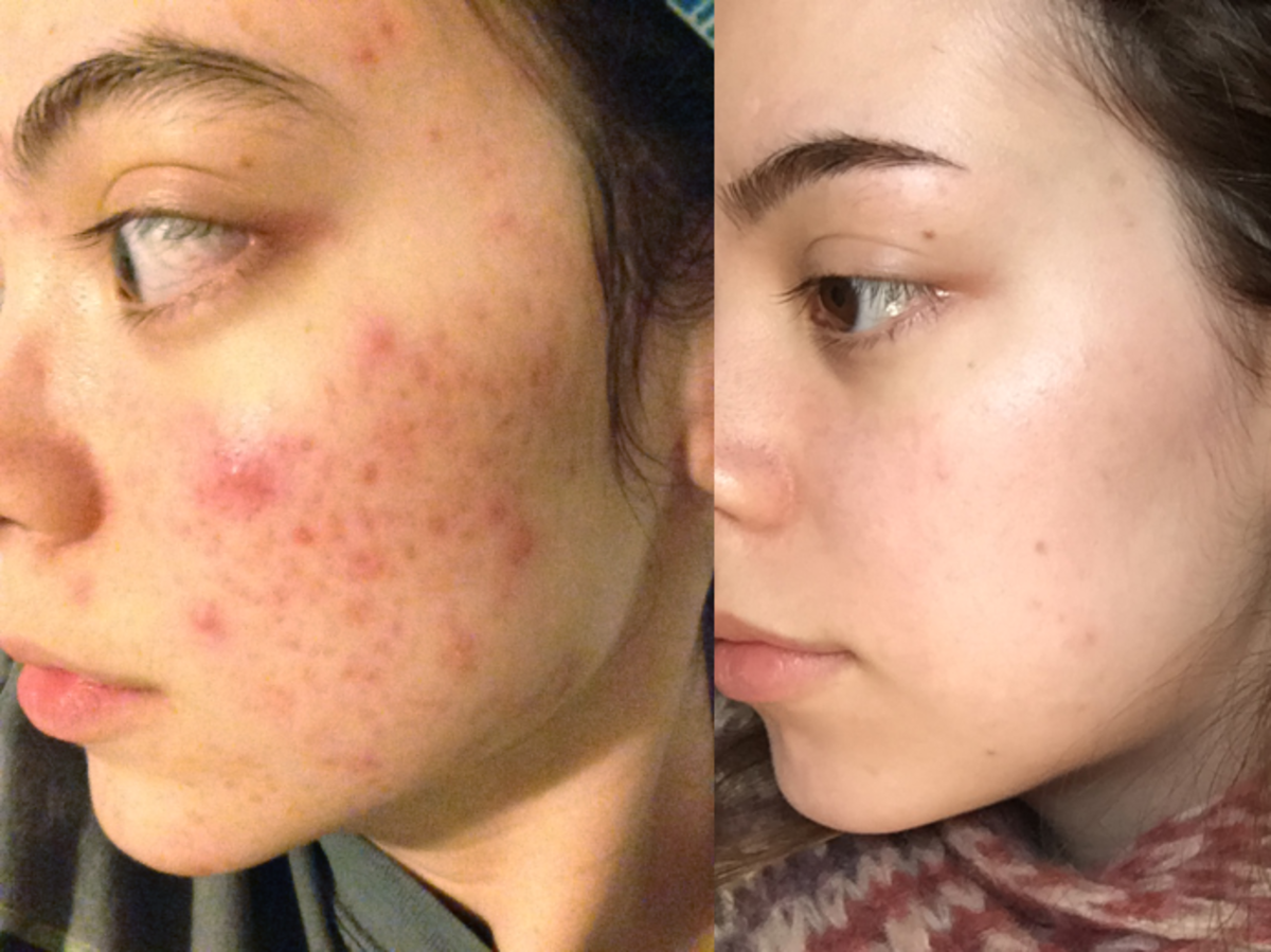 zdjęcia przed i po dziewczyna która wyleczyła trądzik olejem z konopi